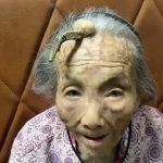 Idosa de 107 anos chama atenção por crescimento inusitado na testa: um “chifre”!